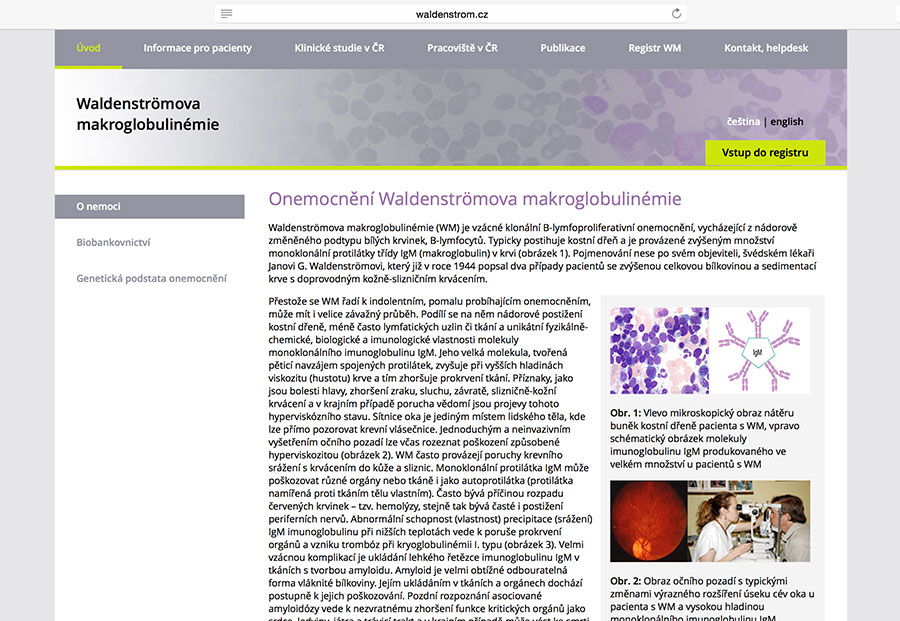 Waldenströmova makroglobulinémie: vzácné klonální B-lymfoproliferativní onemocnění, vycházející z nádorově změněného podtypu bílých krvinek, B-lymfocytů